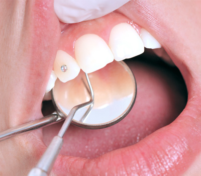 Pose d'un bijou pour les dents : strass dentaire